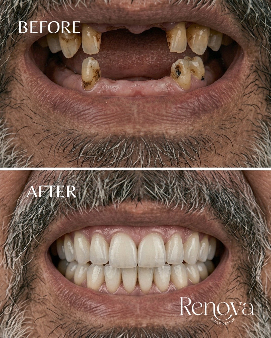 Before and after full-mouth dental implants at Renova - failing teeth restored